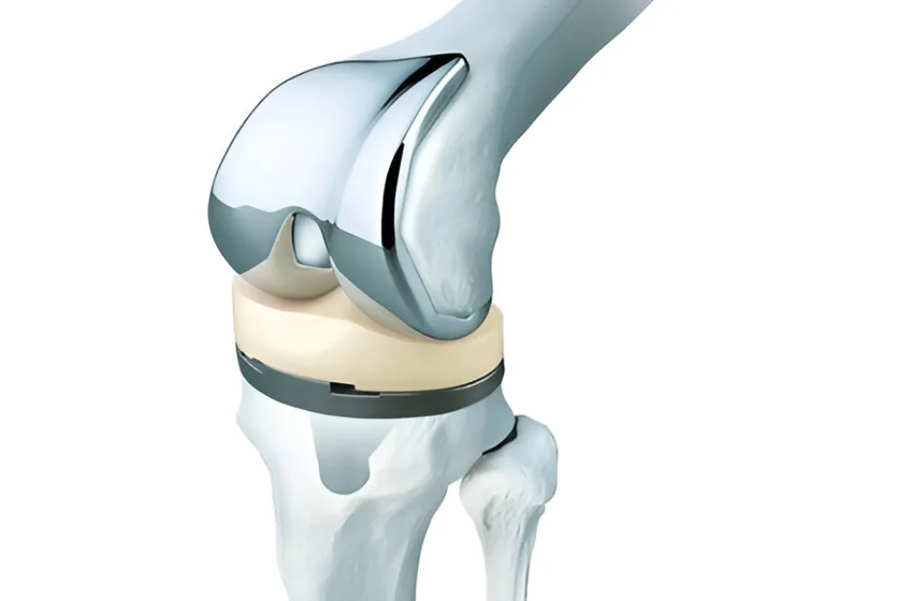 Artroplastia total de rodilla